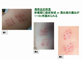 gワクチン接種の実際 日本ビーシージー製造株式会社 Japan g Laboratory